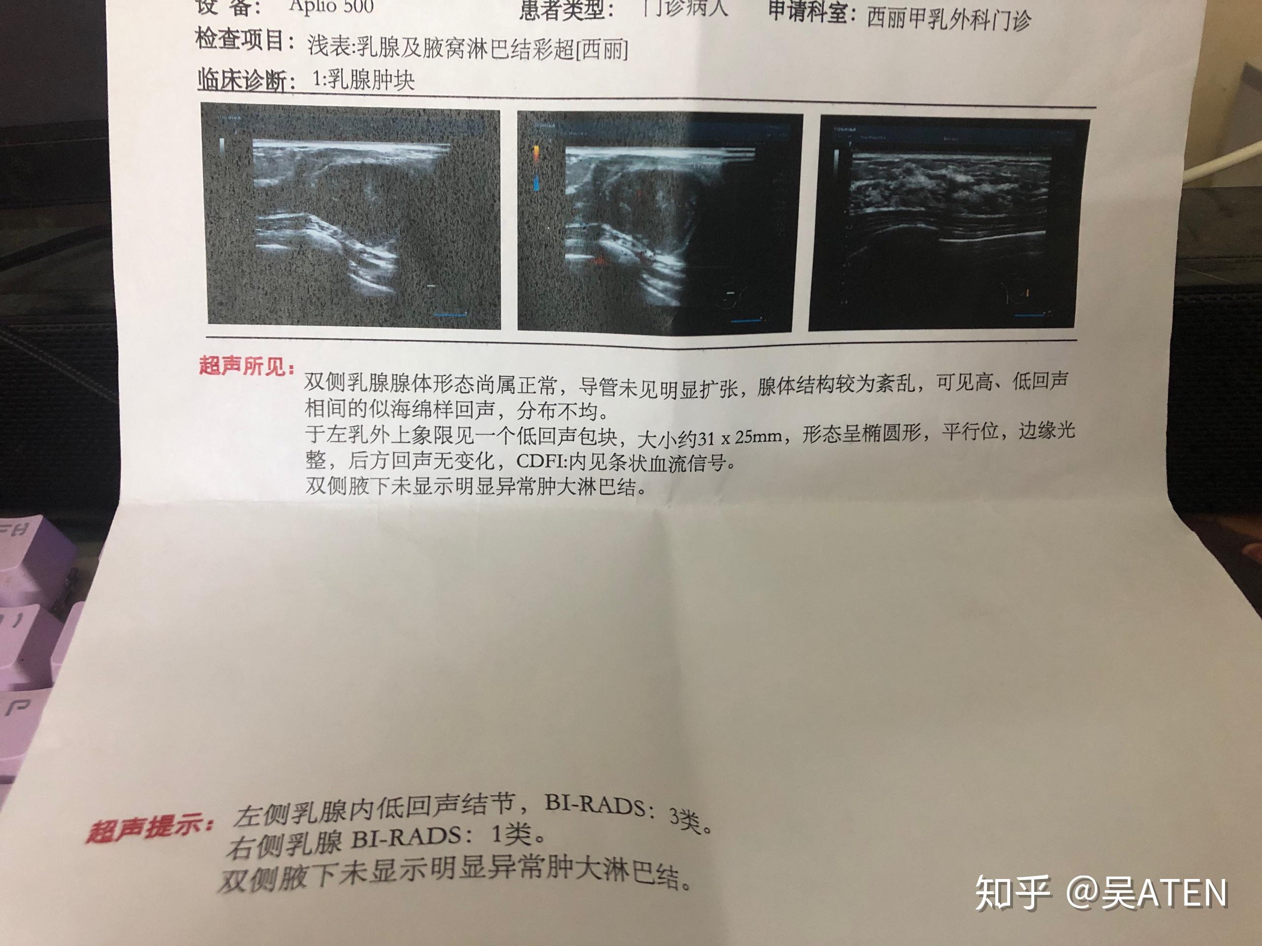 乳腺纤维瘤手术全记录
