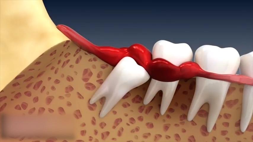 拔除牙胚(智齿)