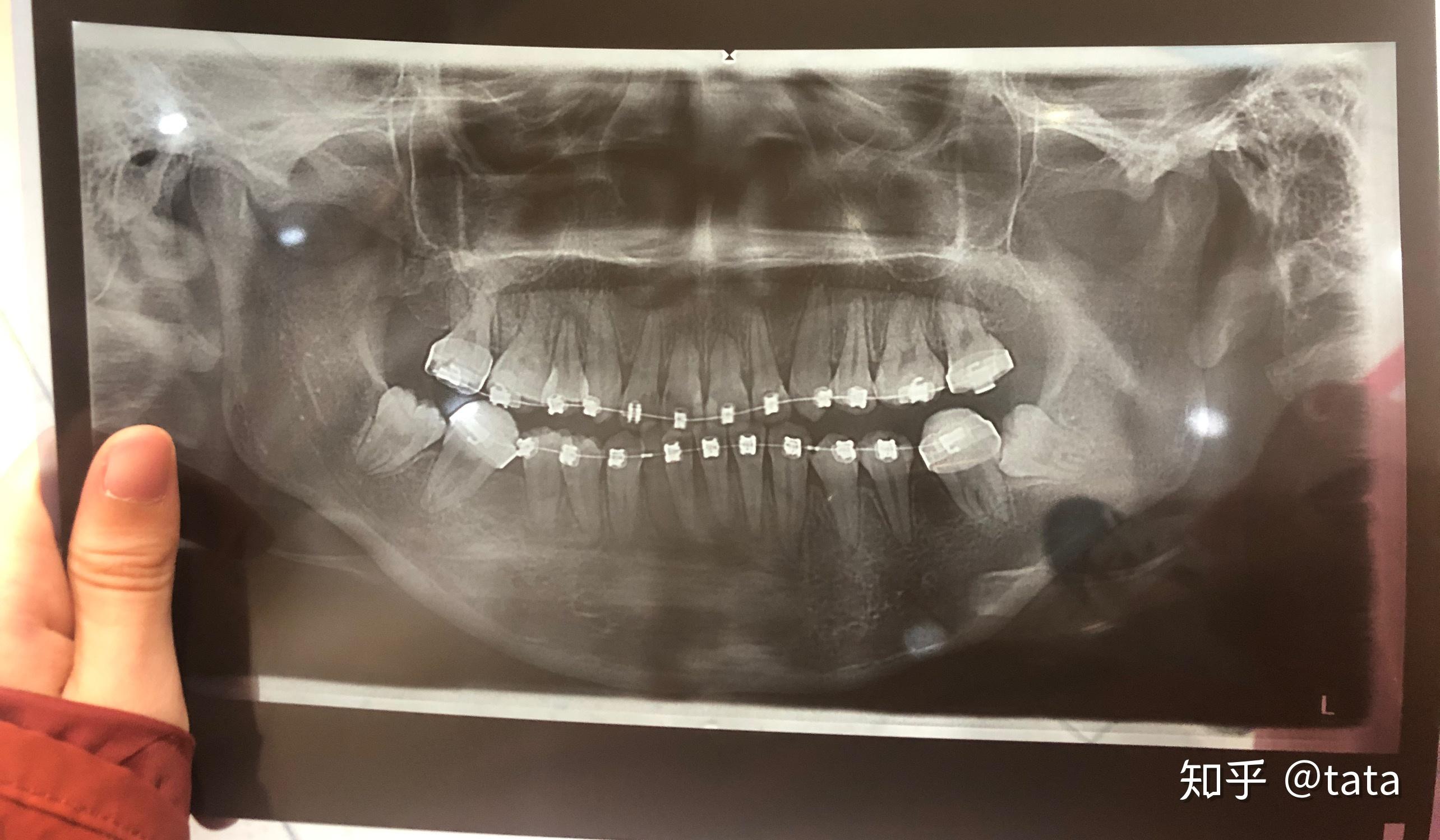这个牙槽骨吸收严重吗智齿可以用来牵引吗求大神解答