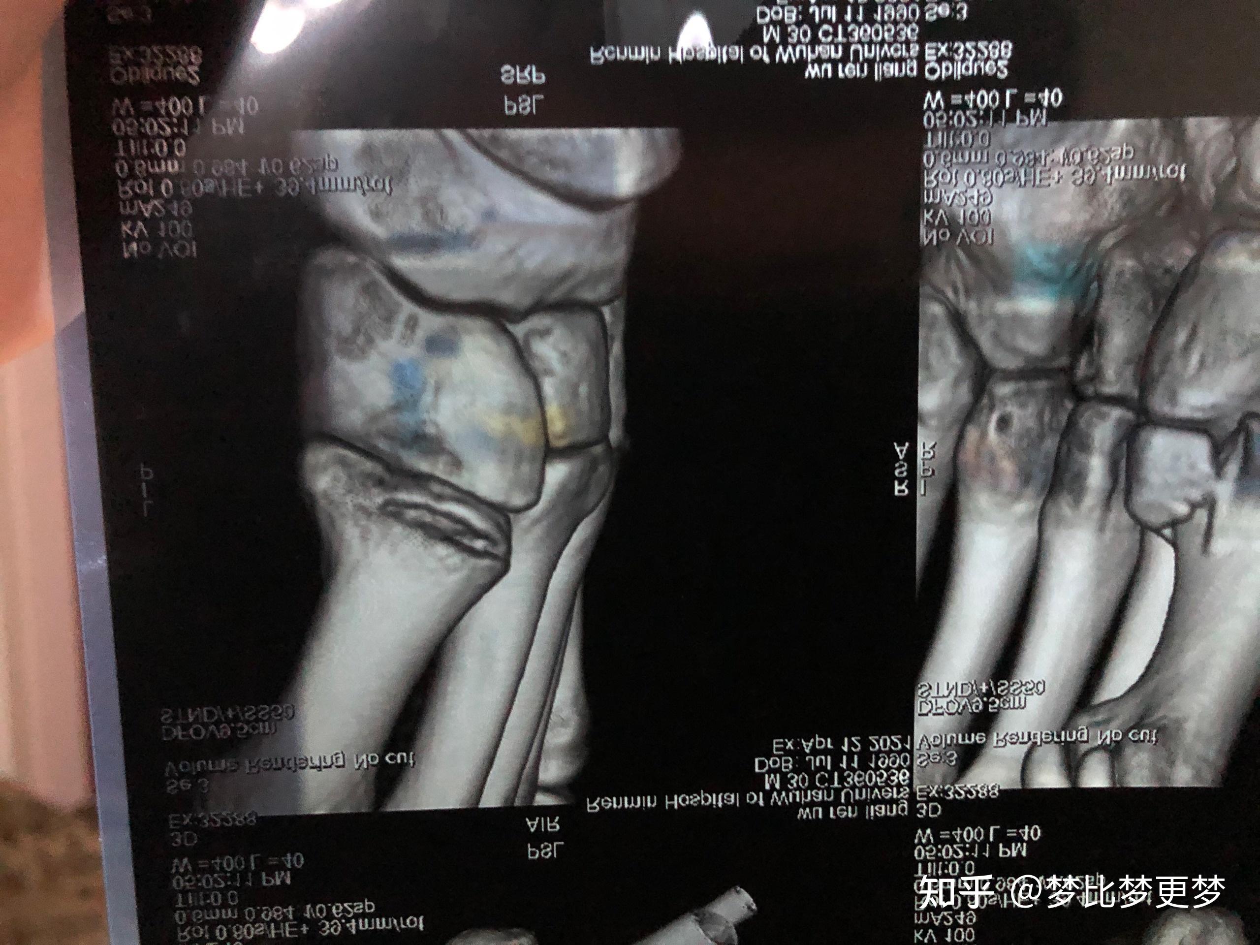 右脚第一跖骨基底部骨折日志