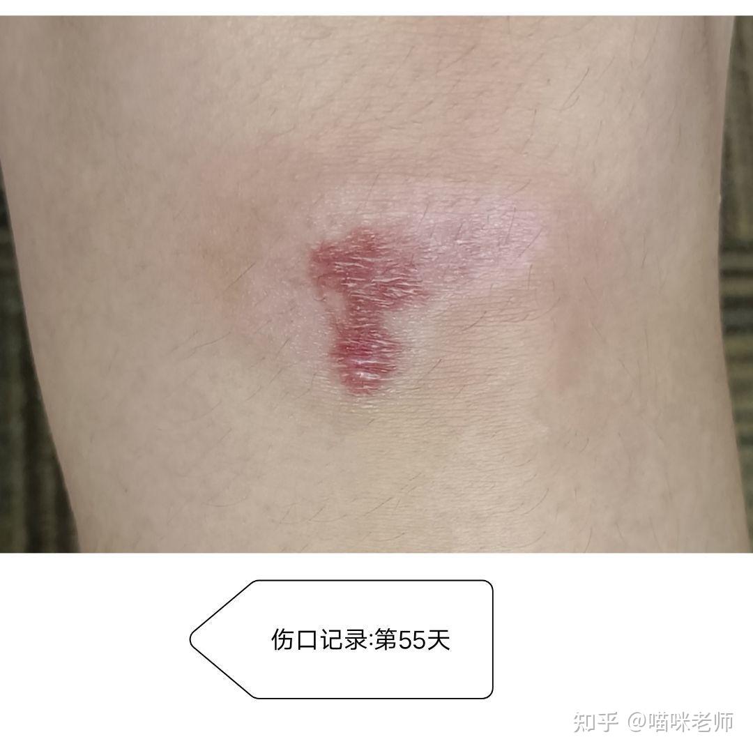 【第85天】皮肤红色范围也开始长汗毛!真棒!【第100天】颜色越来越浅.