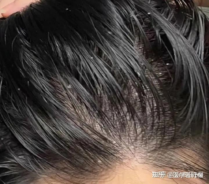 从专业角度来讲,真菌感染造成的头屑为何难以消除呢?有什么亲测有效的去屑方法? - 知乎