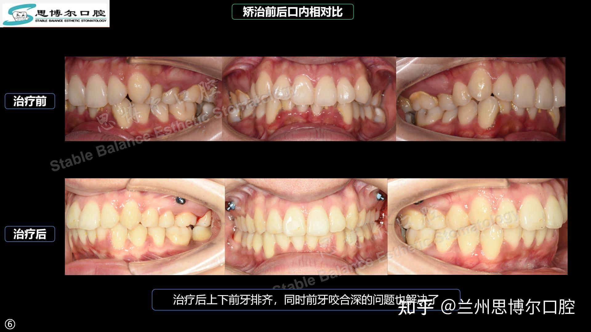 下颌双侧第二磨牙近中倾斜矫治案例