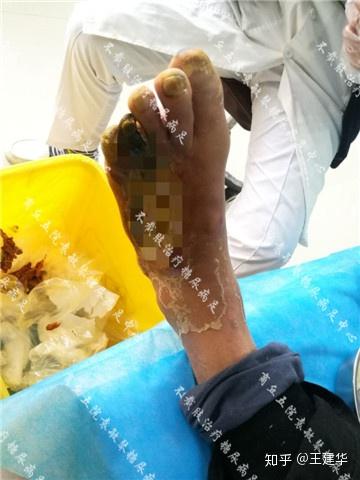 糖尿病患者脚趾发黑没有及时采取治疗后来的他是这样的