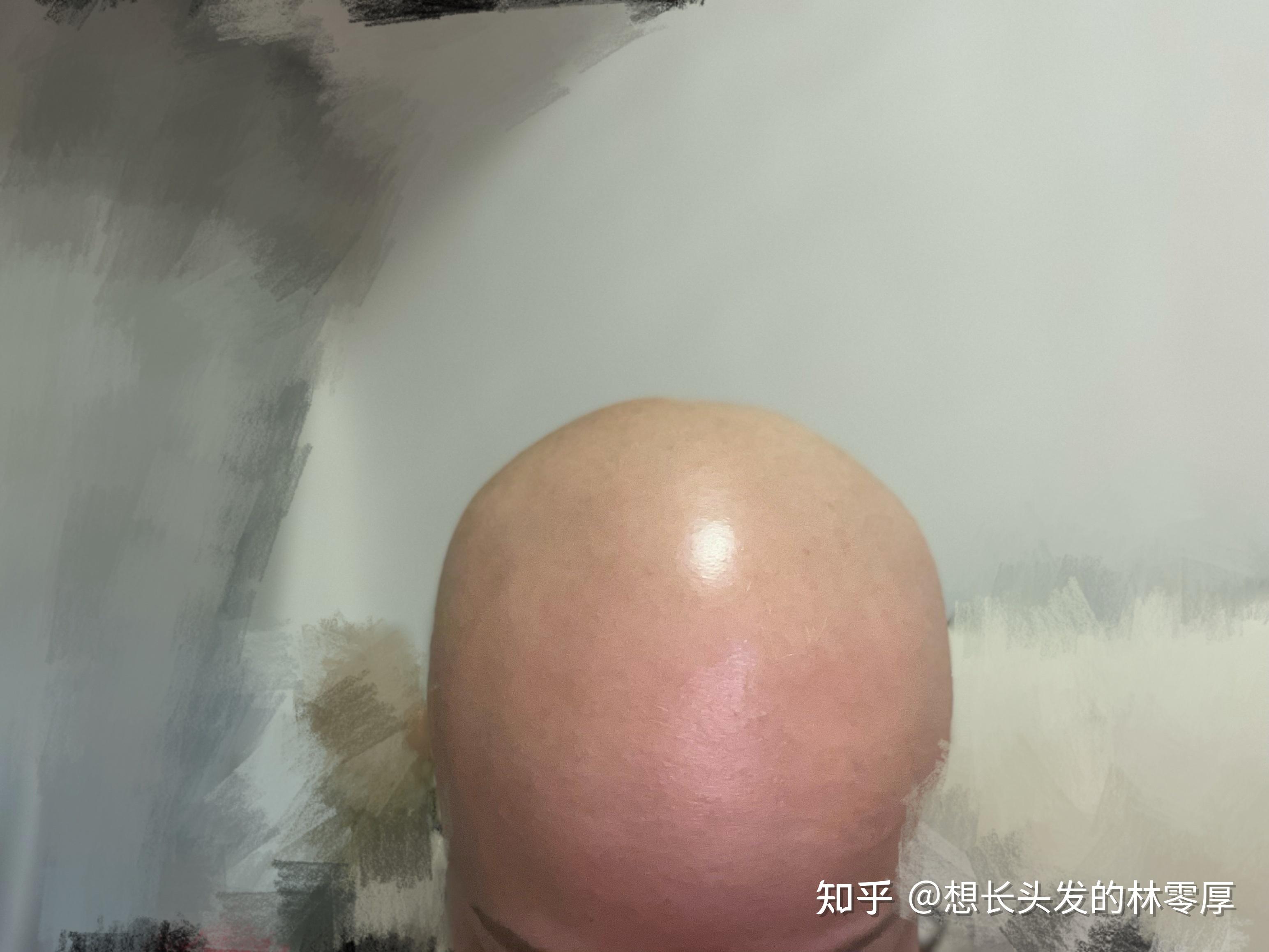 普秃六年还在积极治疗不放弃