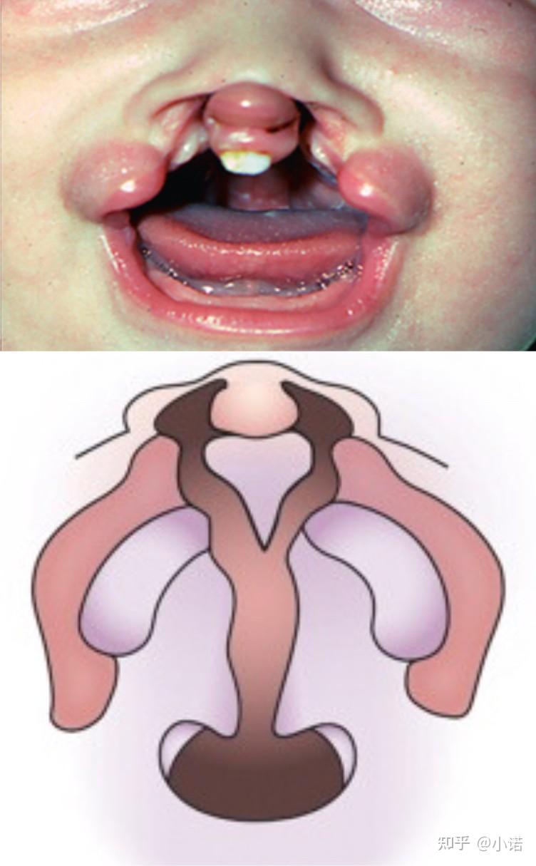 唇腭裂患儿的牙槽嵴裂几岁做好—些?