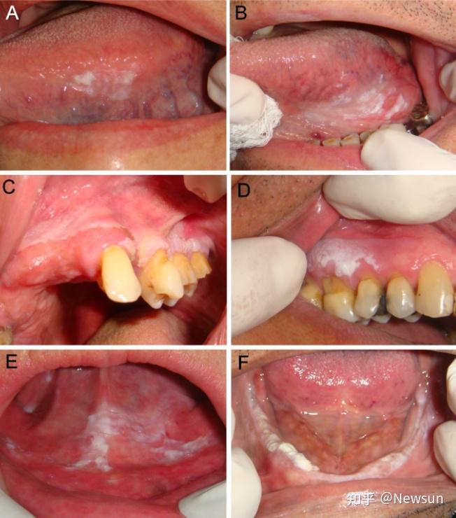 6.口腔白斑