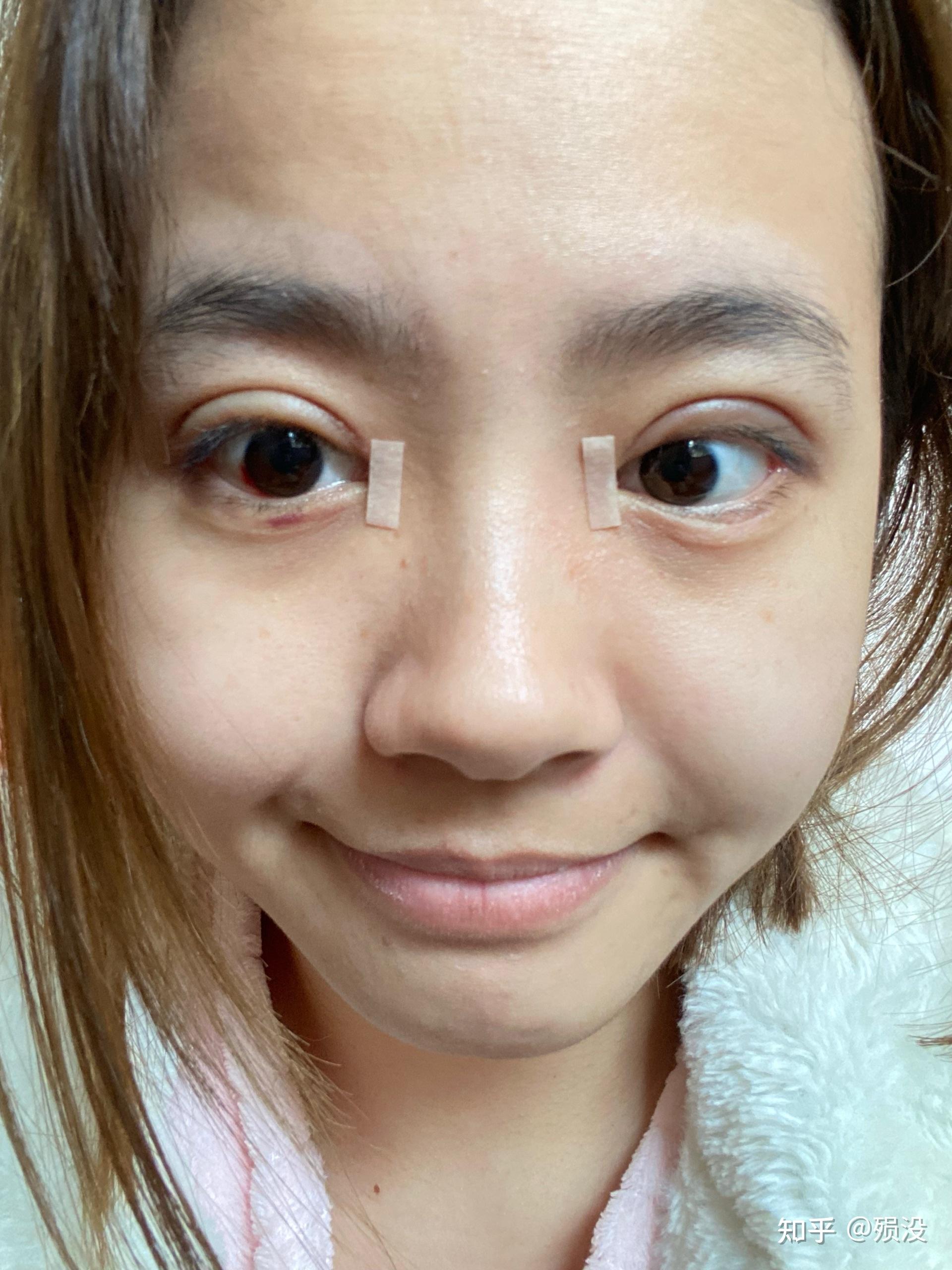 我的大小眼割双眼皮恢复日记63