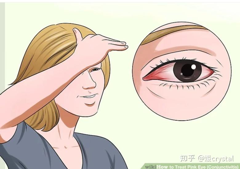 孩子突然眼睛红痒多种眼药水无效为何小心春季卡他性结膜炎
