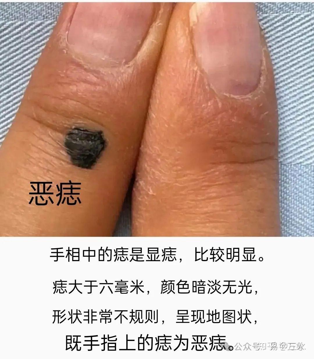 手相中的好痣和恶痣都在什么位置？ - 知乎