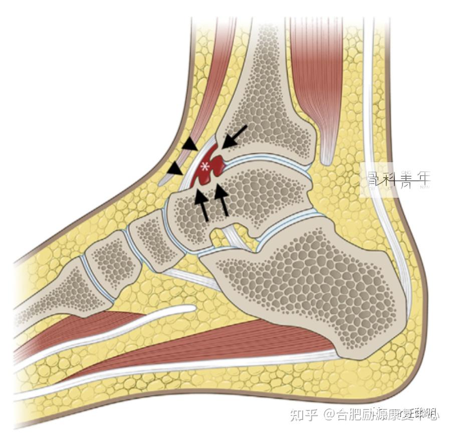 踝关节撞击综合征:踝关节慢性疼痛最常见的原因