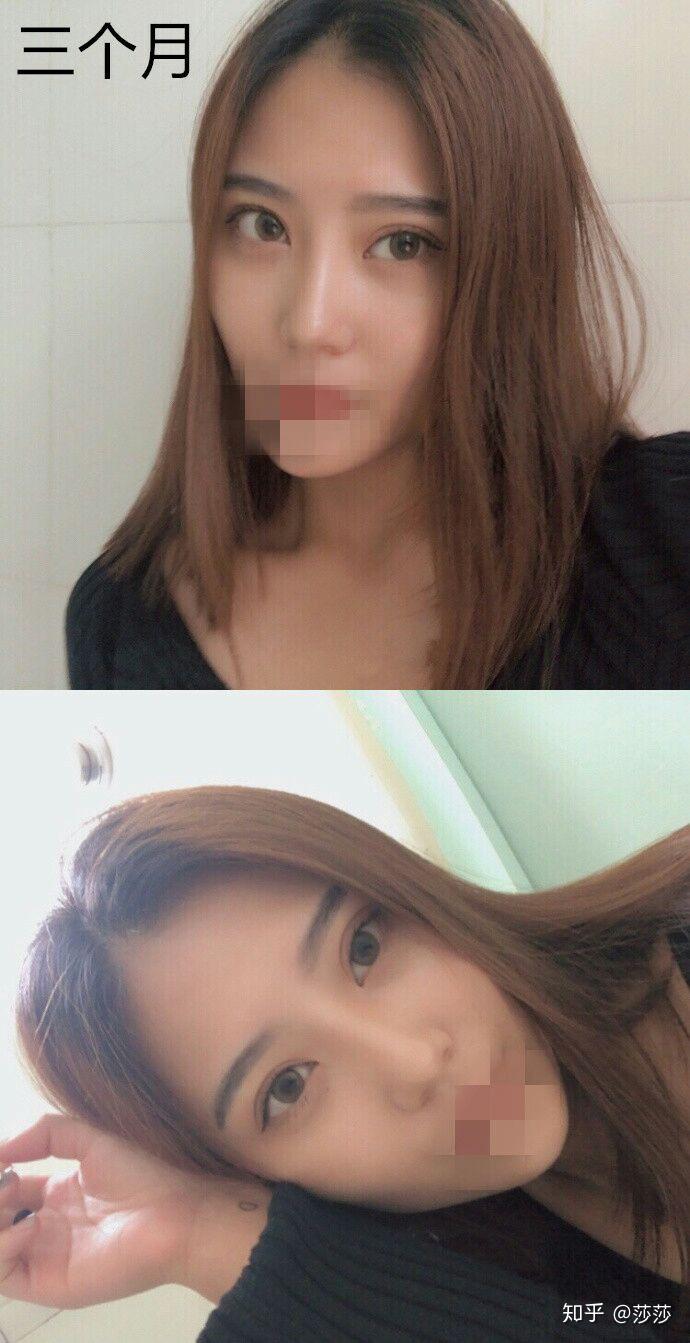 郑州两次埋线双眼皮修复加开内眼角恢复过程分享已经两年了超级自然