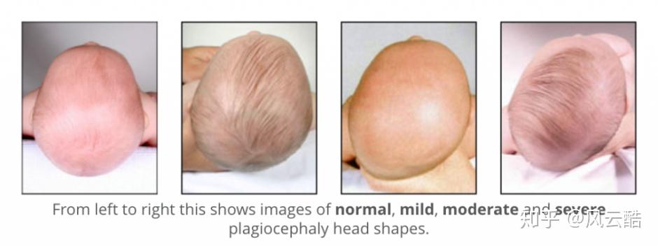 从头顶观察,会看到宝宝后脑勺左右是不对称的.