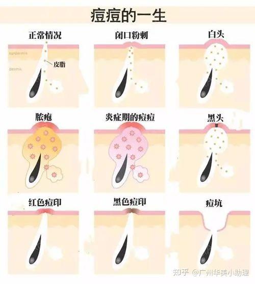 6个有效淡化痘印的医美项目，你清楚了吗？ - 知乎