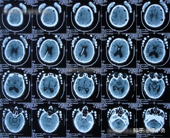 81岁老年脑积水腰大池分流术反致颅内感染颅内出血及走路不能2年余