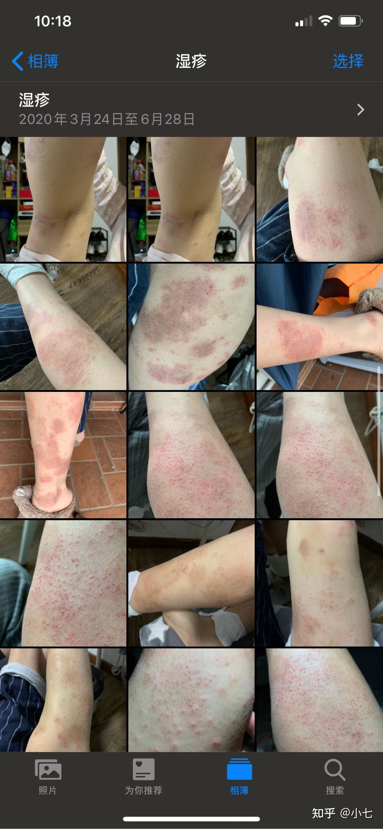 狠下心3个多月断湿疹根