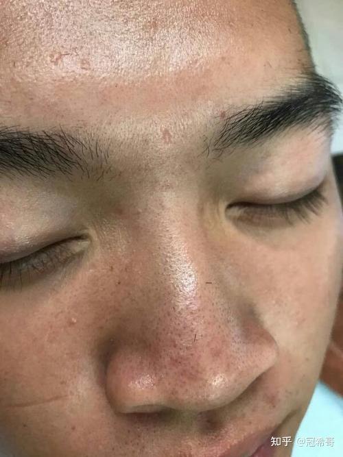 男士如何去黑头有没有去黑头方法推荐