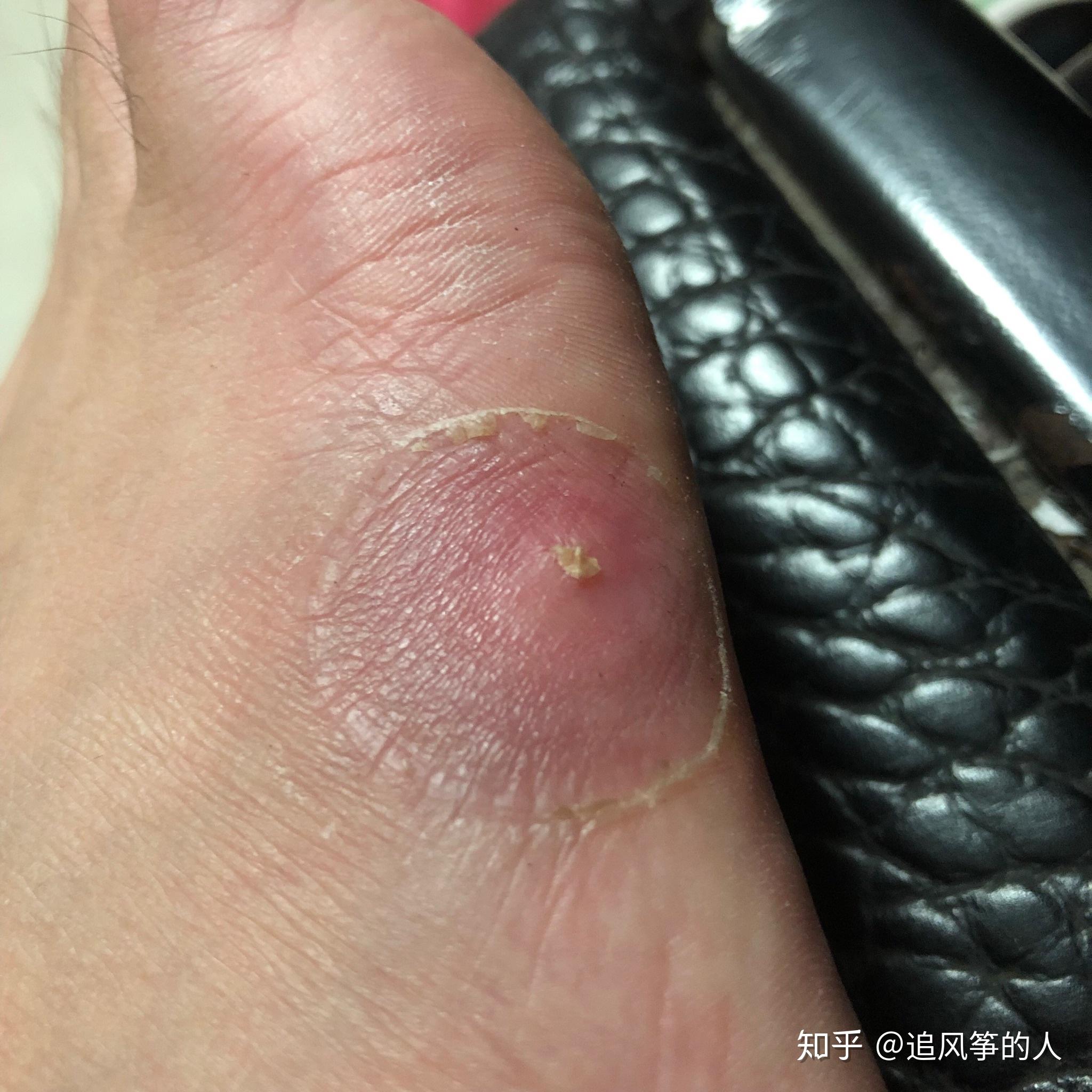 记录治疗寻常疣的日子