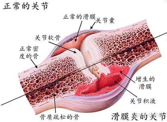 滑膜炎是滑膜受到各種刺激(如創傷,感染,骨質增生, 結核,關節退變