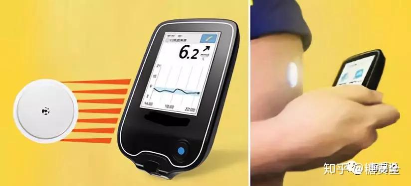 史上最in血糖监测扫描式动态葡萄糖监测技术不扎手指测血糖