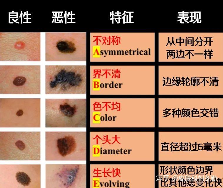 身上这种痣,要不要点? - 知乎