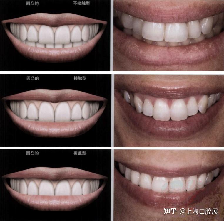 美学修复治疗中的分析设计 - 知乎