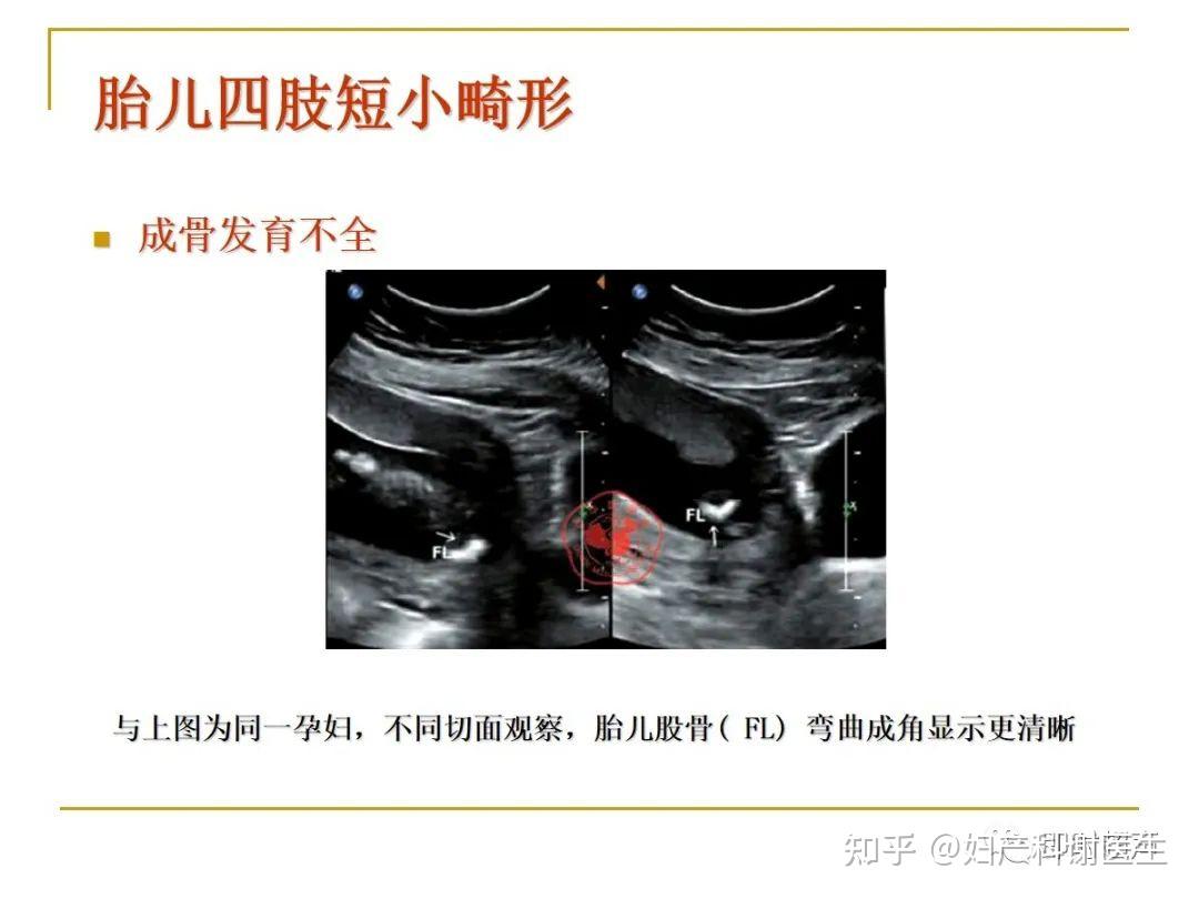 明明白白做超声(十一)：胎儿腹部超声检查 - 知乎