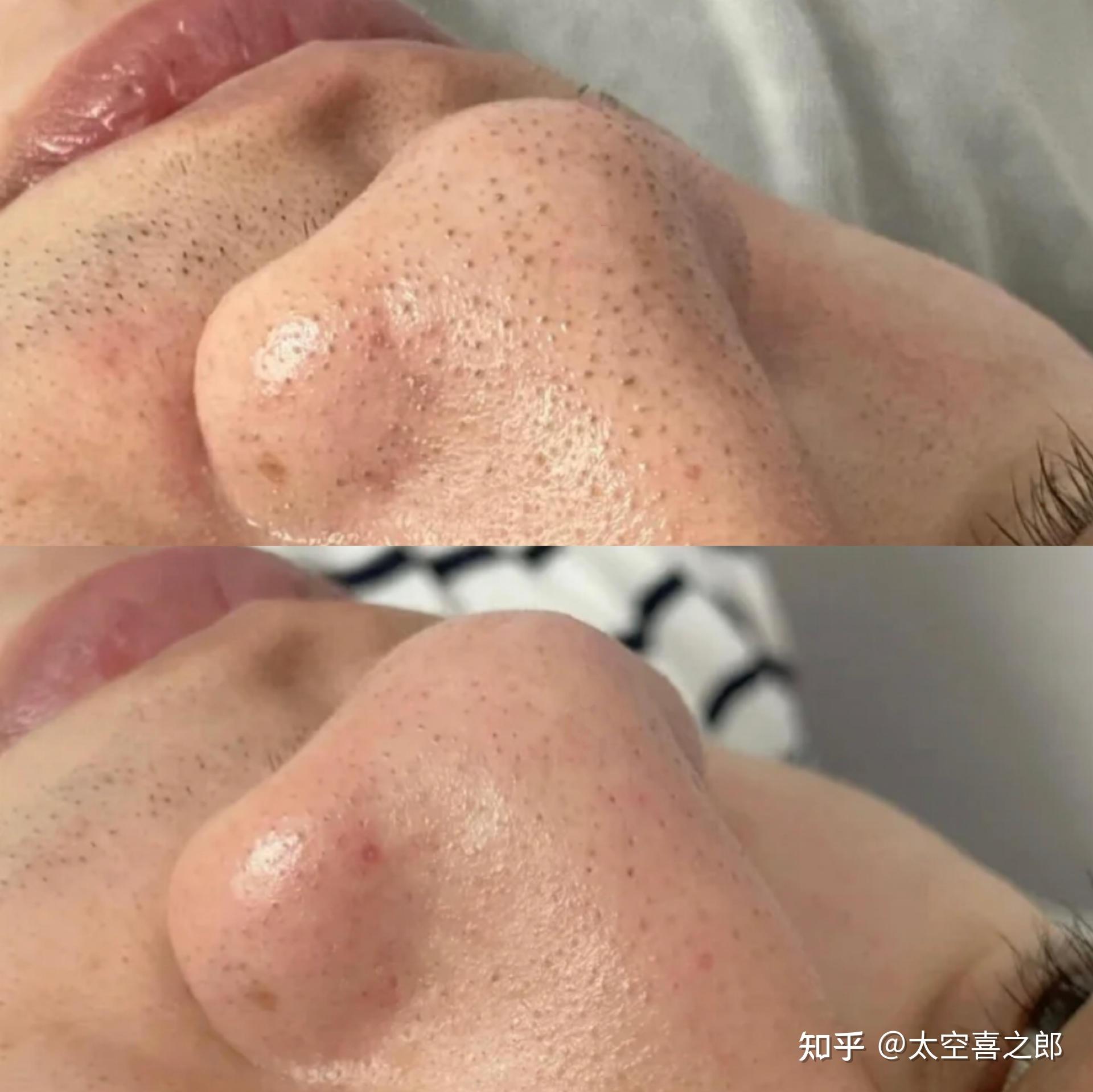 第一,去黑头 抑痘两手抓