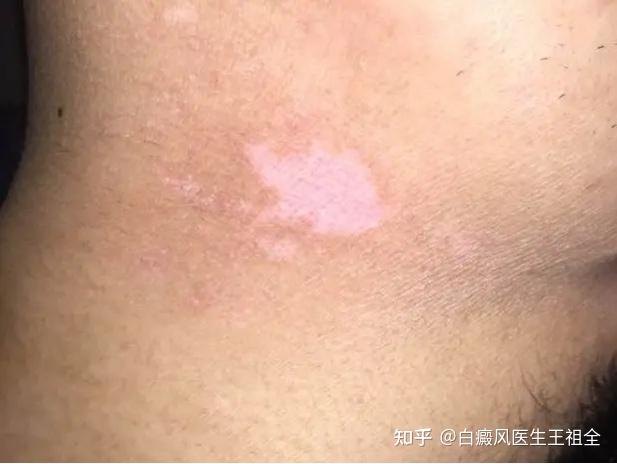 白斑摩擦变红是不是白癜风,白癜风症状都有哪些?