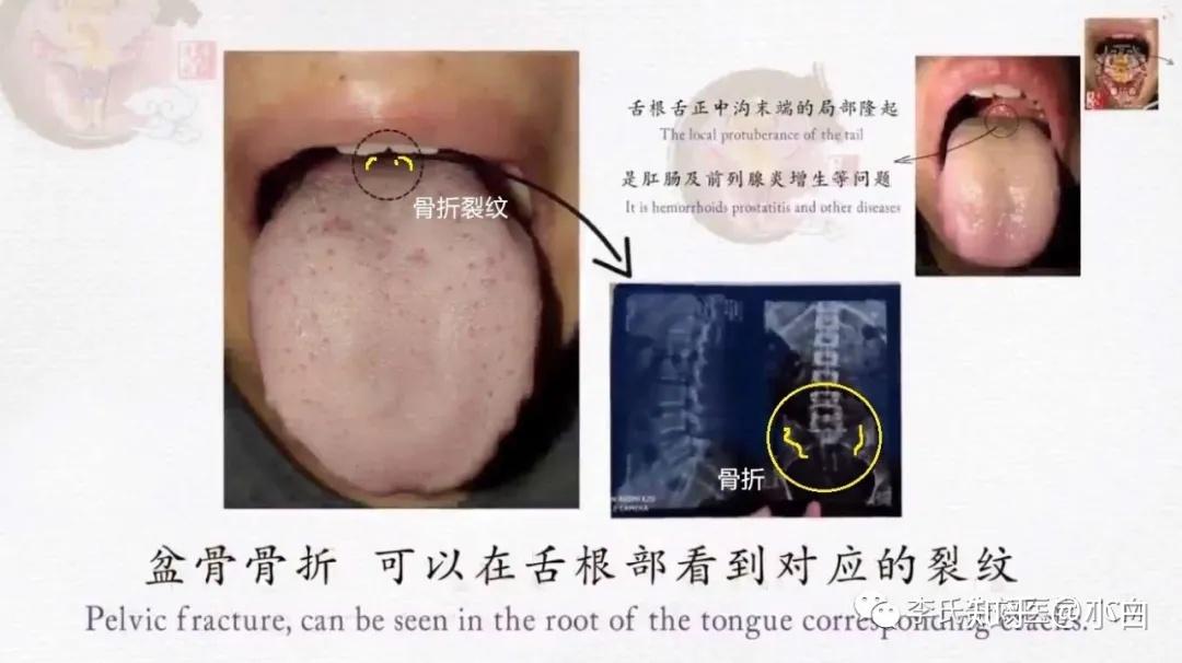 舌根与肾李芳祥奇效舌诊动画版