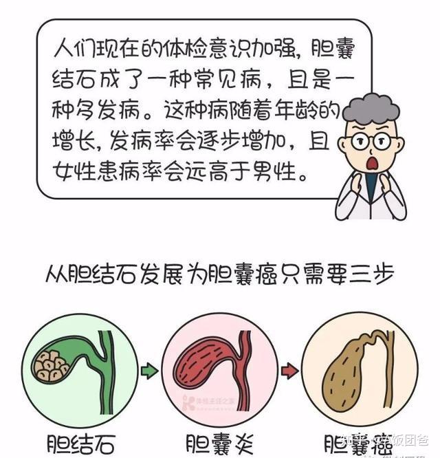 体检发现胆结石胆囊非要切除吗珍锦堂告诉你