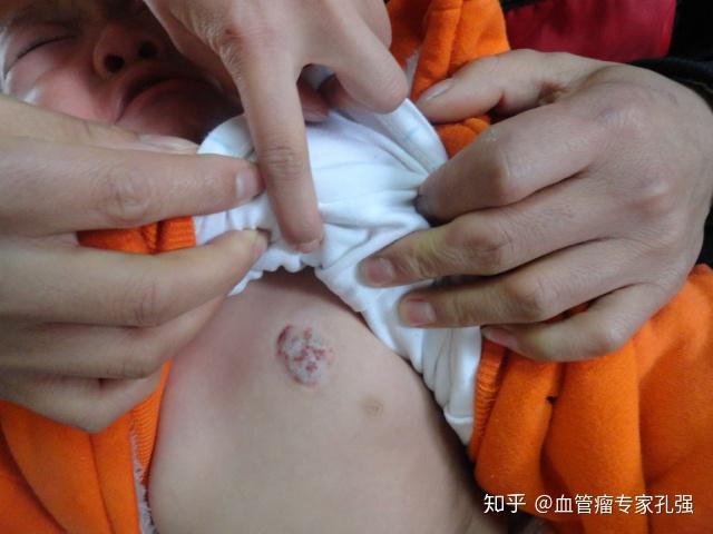 血管瘤破裂后的急救措施