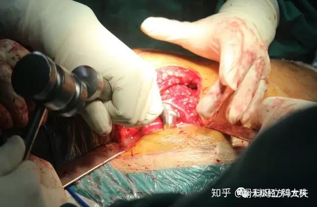 手术过程股骨头坏死全髋关节置换术