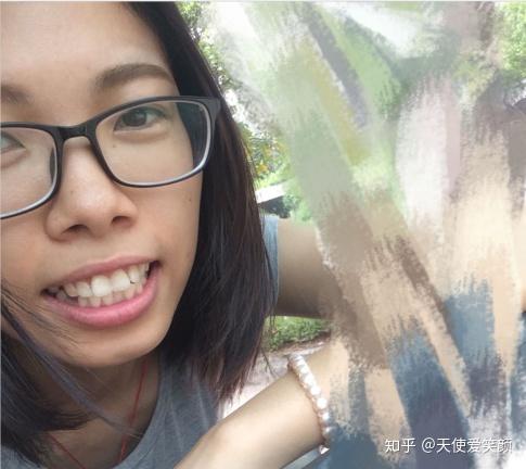 正畸分享|骨性龅牙,异地矫正,2年的牙套时光 - 知乎