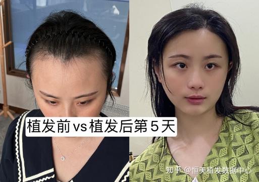 深圳那里植发技术好(深圳哪里植发手术医院好)