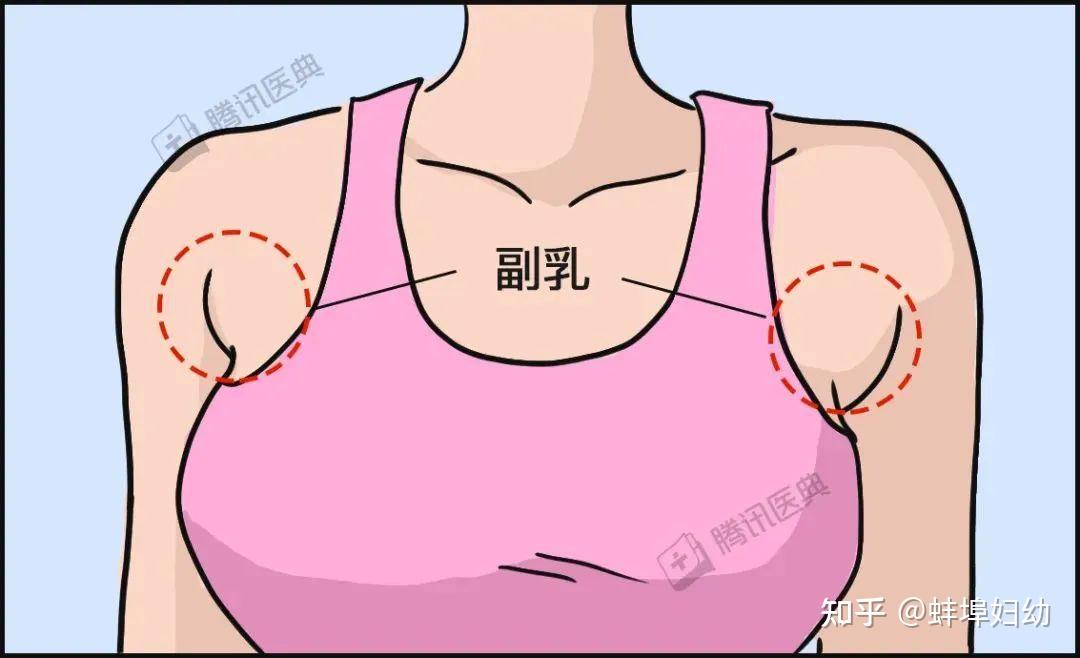 支招 | 身上有多个乳头,需要手术治疗吗?