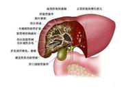 肝结石怎么引起的 zhuanlan.zhihu.com