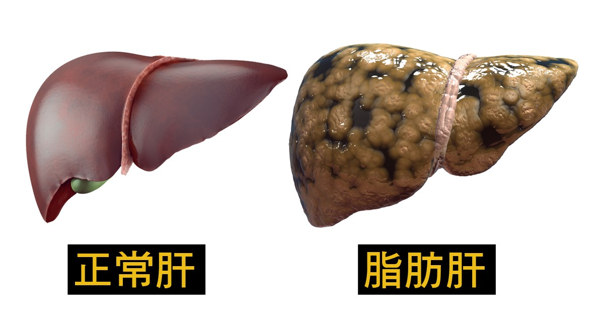 饮食建议患有脂肪肝该如何吃