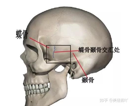 一文教你看懂:你到适合颧骨内推,还是填充太阳穴,别再被坑了! - 知乎