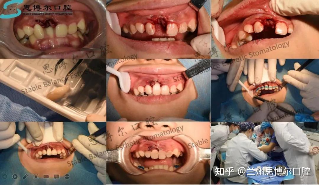 手术复位图牙脱位要怎么办及时找到完全脱落的牙齿后,迅速用流水冲