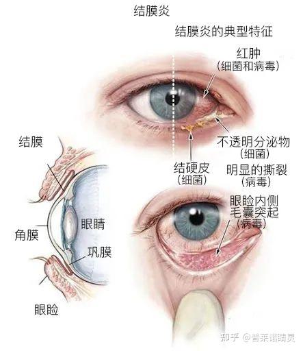 眼结膜炎怎么治疗最快图片