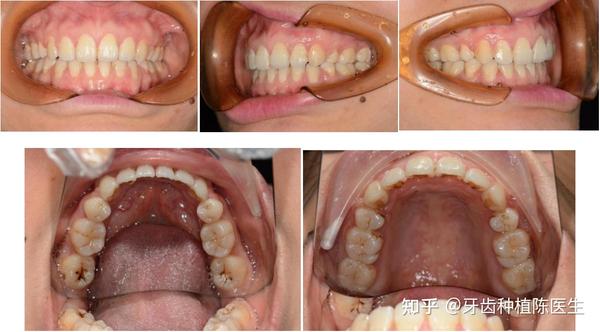 案例一:患者是一个30岁的女孩,牙齿不整齐,很早之前就想去矫正,但是
