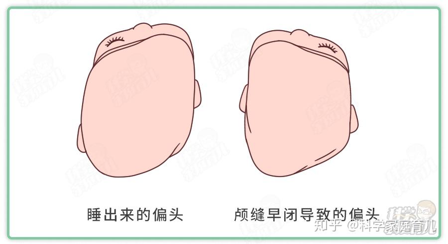 娃偏头、扁头会伴随一生?专家:千万别错过矫正“黄金期” - 知乎