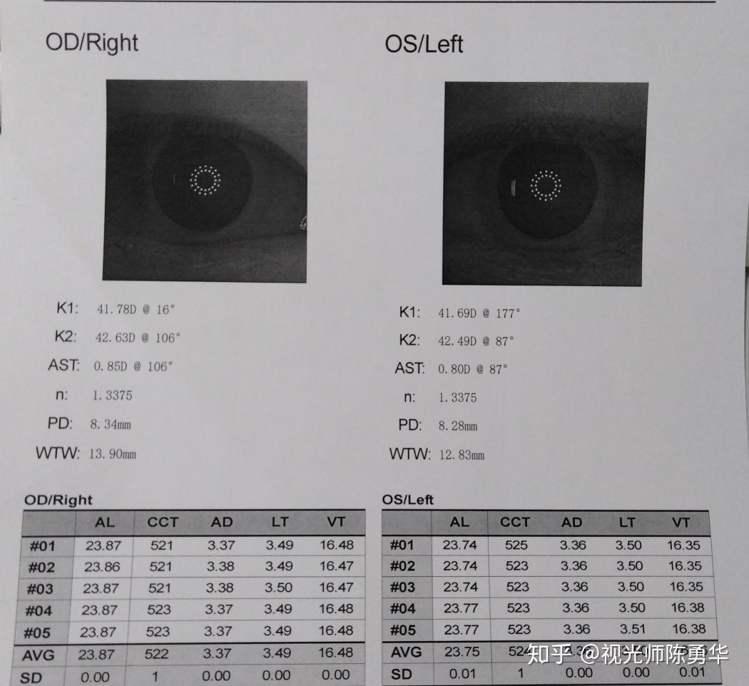 生物测量(眼轴相关)报告解读,附不同年龄段眼轴值