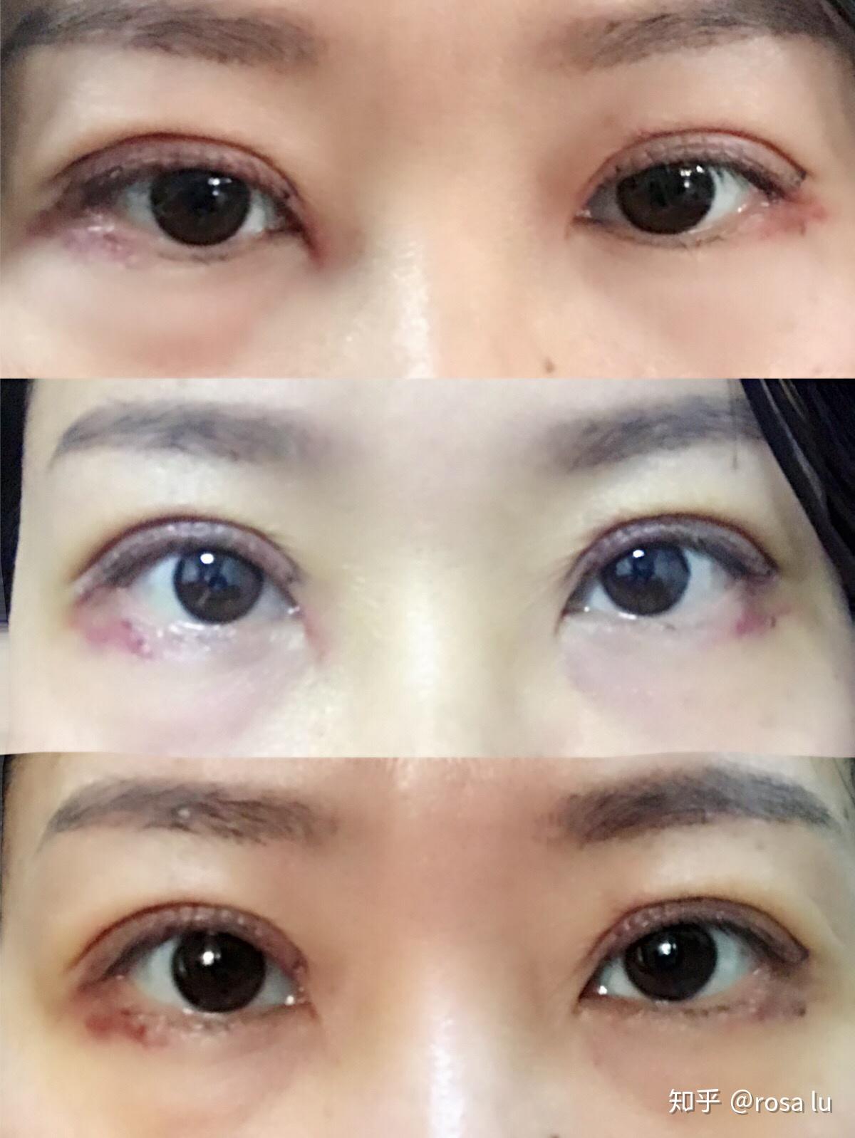 无痕全切双眼皮手术恢复情况分享简单粗暴全是照片
