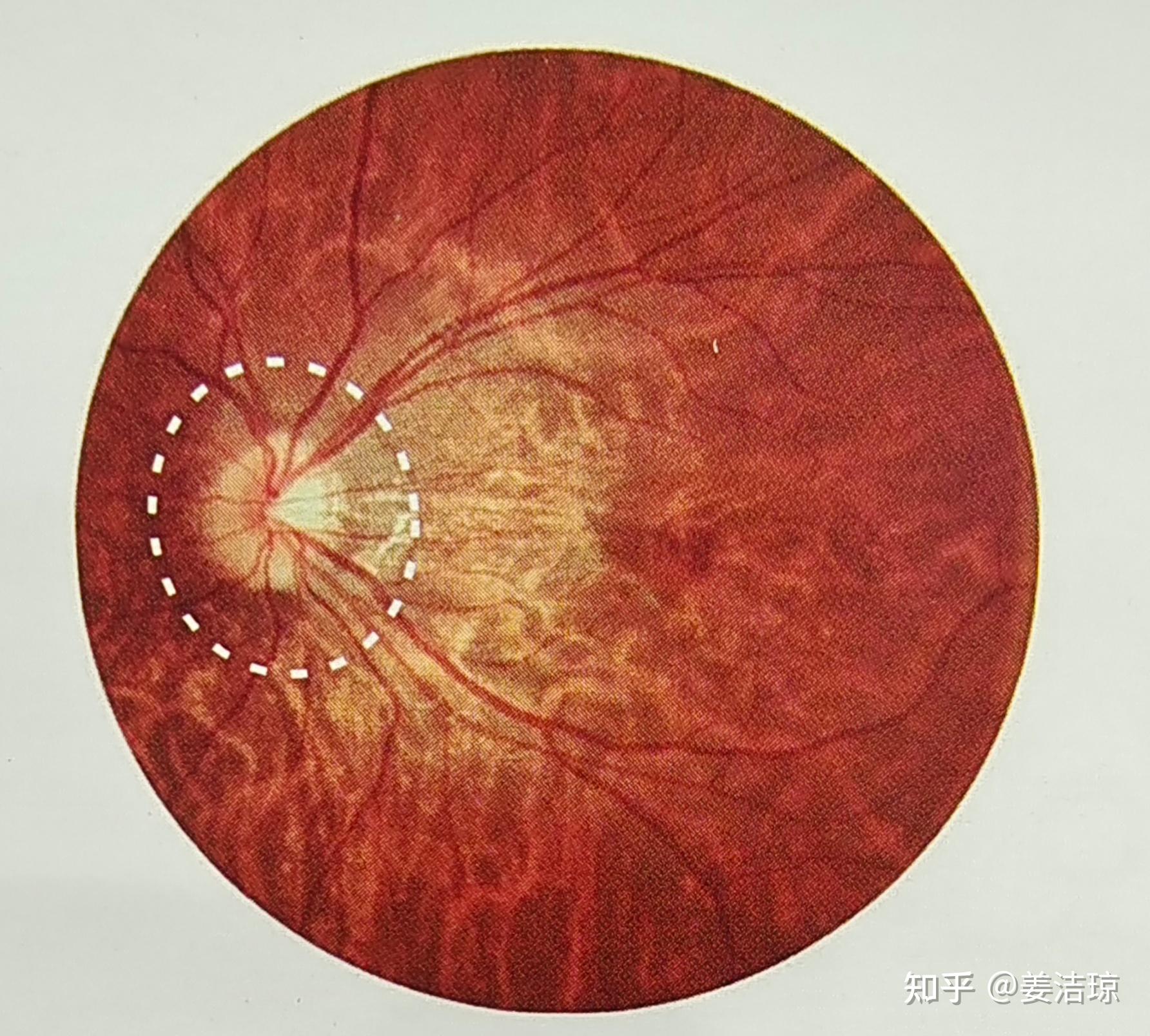 近视（轴性）进展带来的视网膜改变： - 知乎