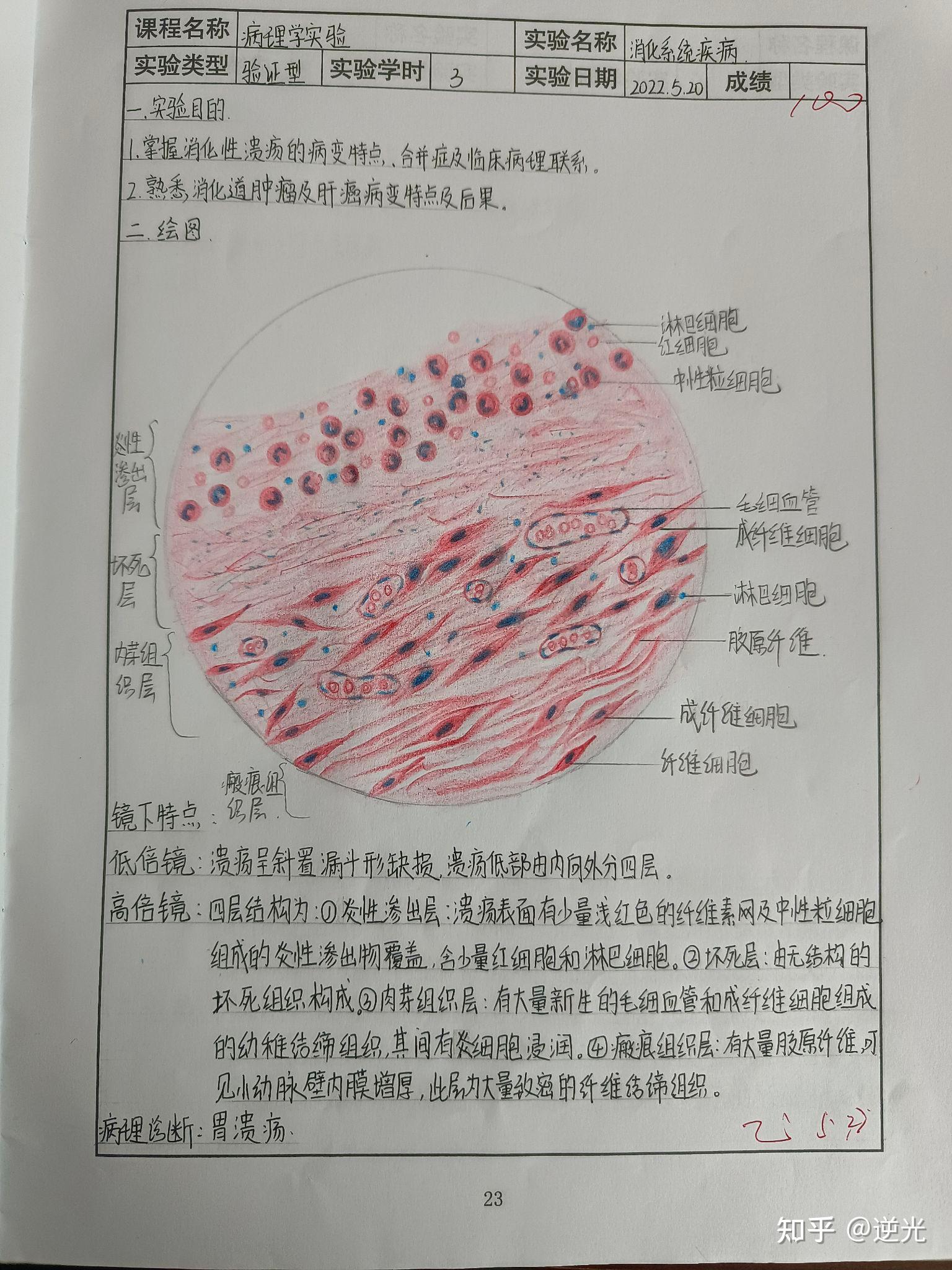 胃溃疡四层红蓝铅笔图图片