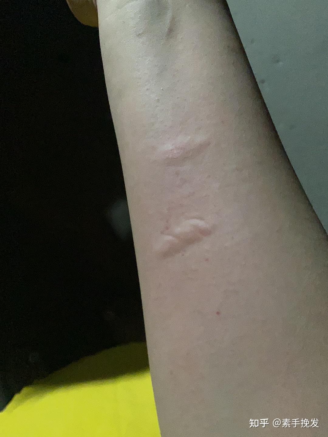 不知道被什么虫子咬了！很痒痒！ - 知乎