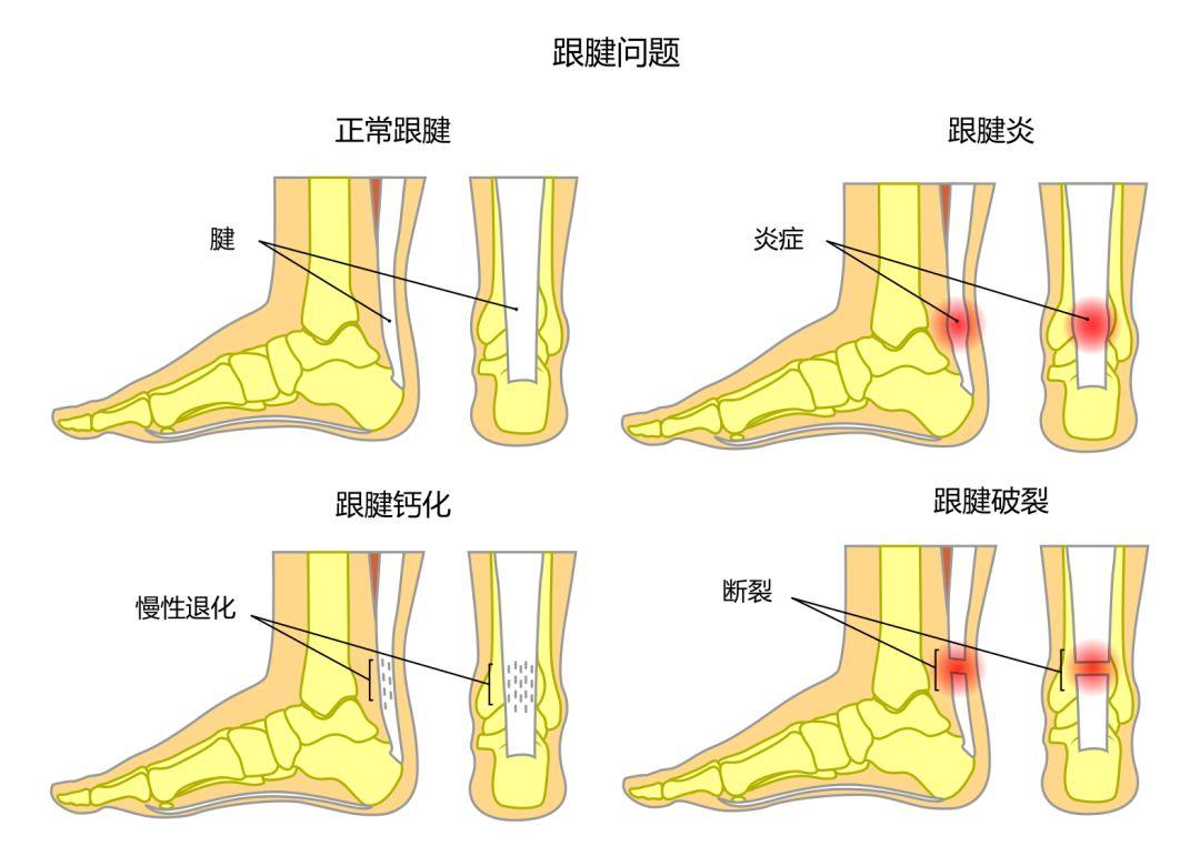 小腿与脚踝相连的地方有一条全身最厚实强壮的韧带称为跟腱,它连接了