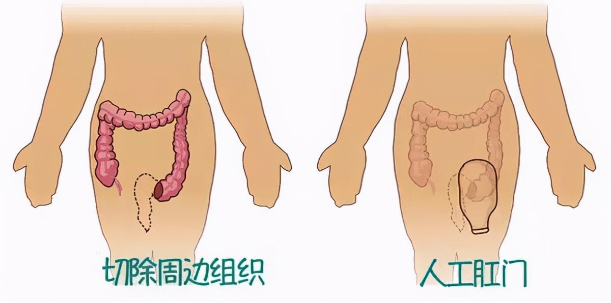 生孩子沒屁眼真是因為父母缺德嗎無肛嬰兒被詛咒後如何救贖